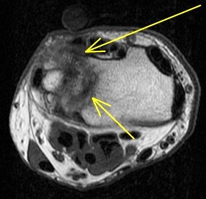 Figure 6 for case Ulnar impingement syndrome
